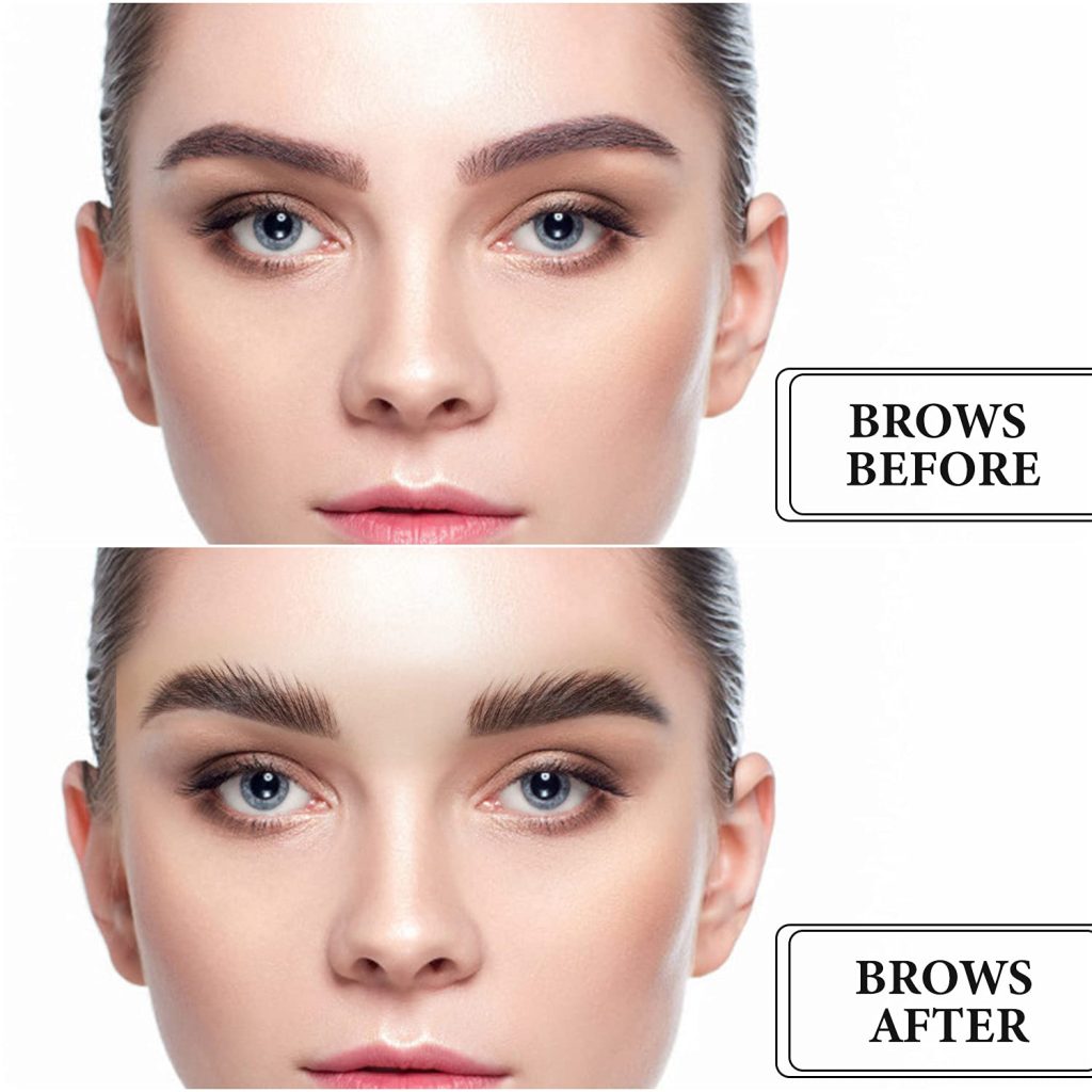 Brow Lifting